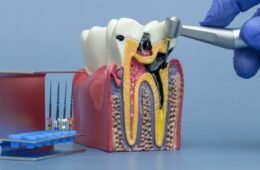 Root Canal Treatment: 7 Things Patients Should Know Before RCT