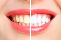 Teeth Whitening in 2026: Professional Whitening vs Home Remedies